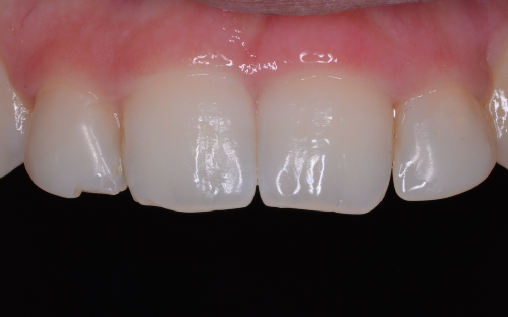 Combination of Gum surgery, composite and ceramics before