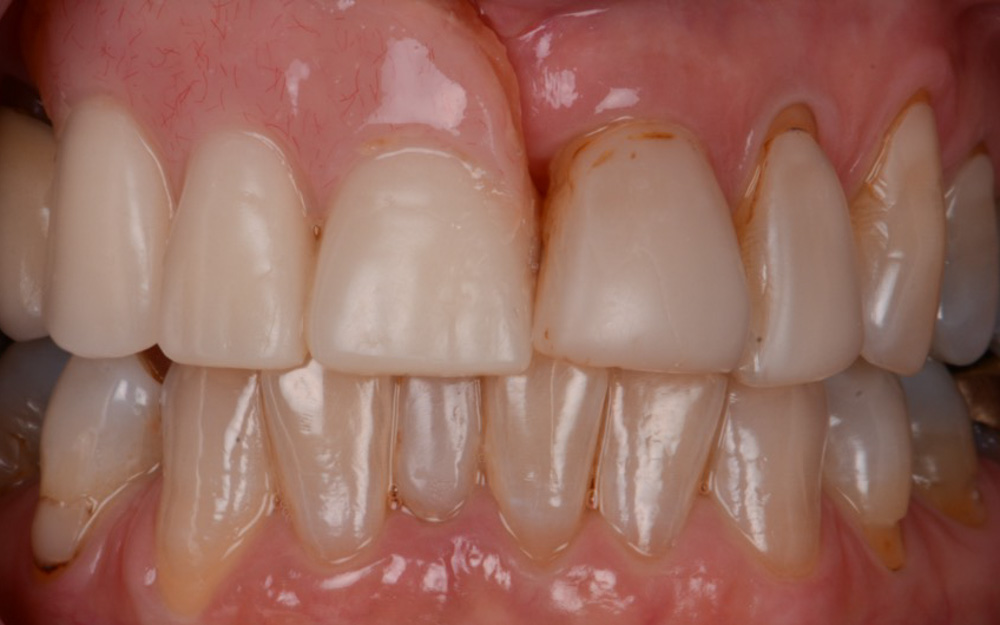 Replacement of Unaesthetic denture with Implant bridge Before