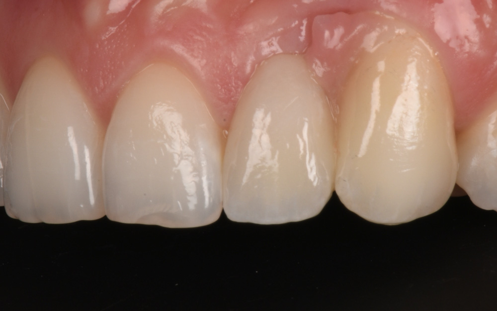 Ceramic bridge replacing Pink gums and Missing teeth after