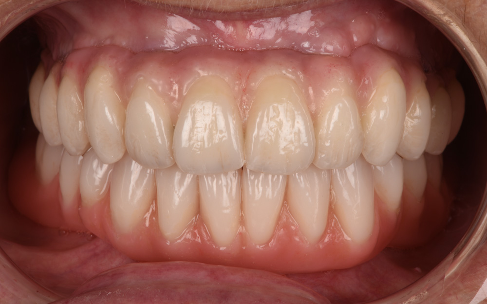 Upper Implant bridge and Lower Implant Overdenture after