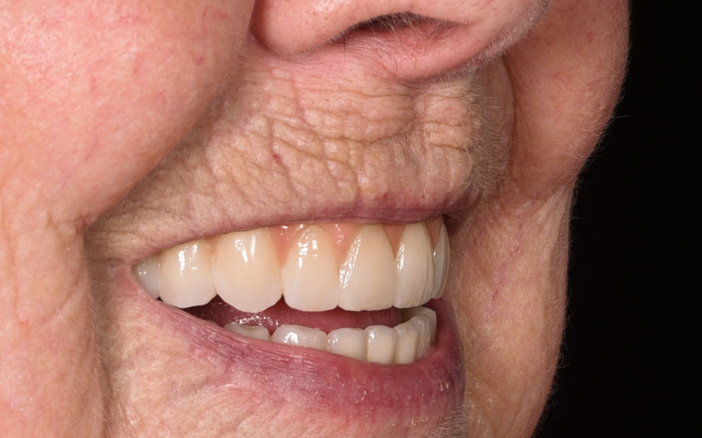 Full arch implant bridges (All-on-4 ) after