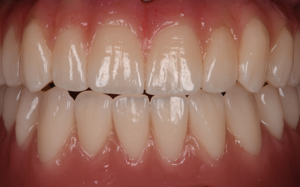 Full Arch Implant rehabilitation (All-on-5) after