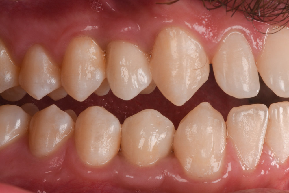 Replacement of congenitally missing premolars After