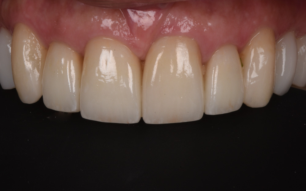 Minimally invasive ceramic veneers after