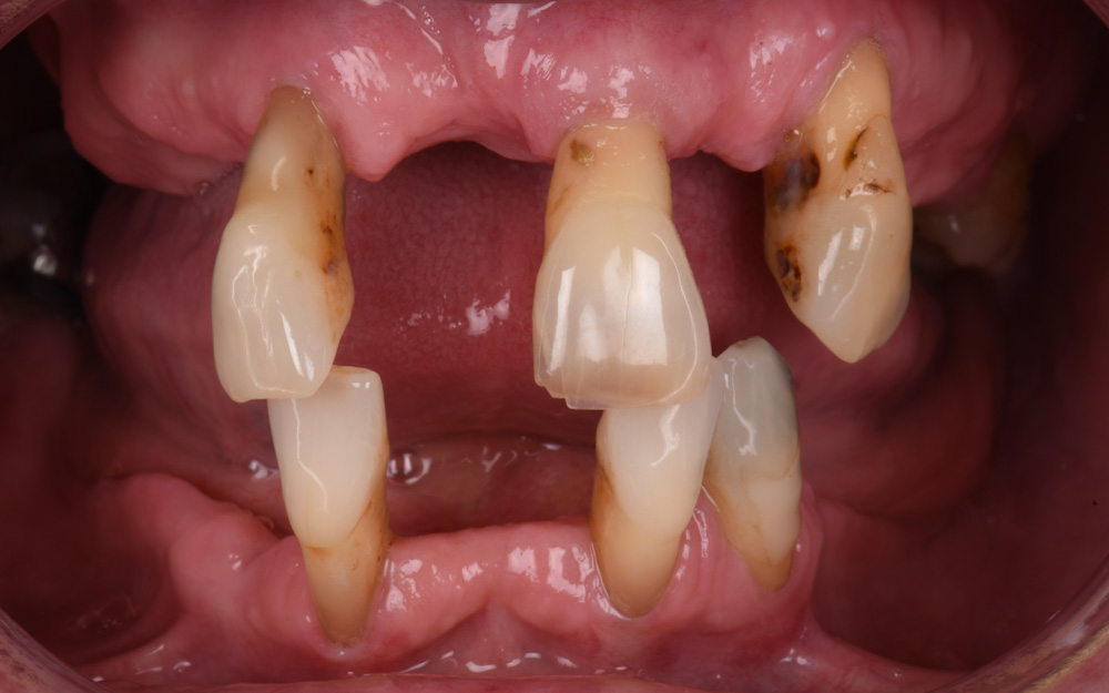 Upper Implant bridge and Lower Implant Overdenture before