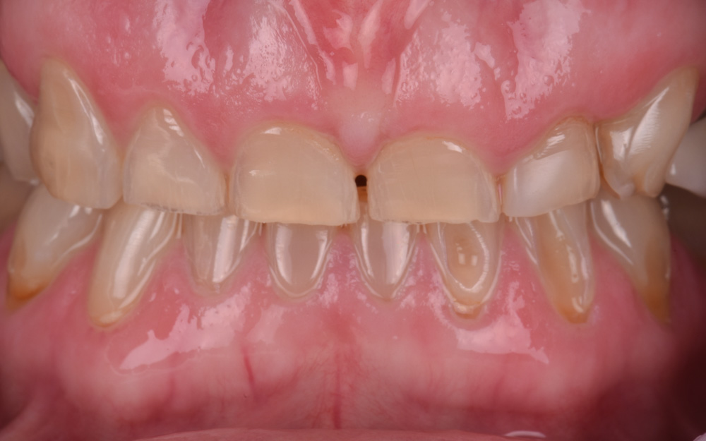 Management of severe tooth wear with composite resin before