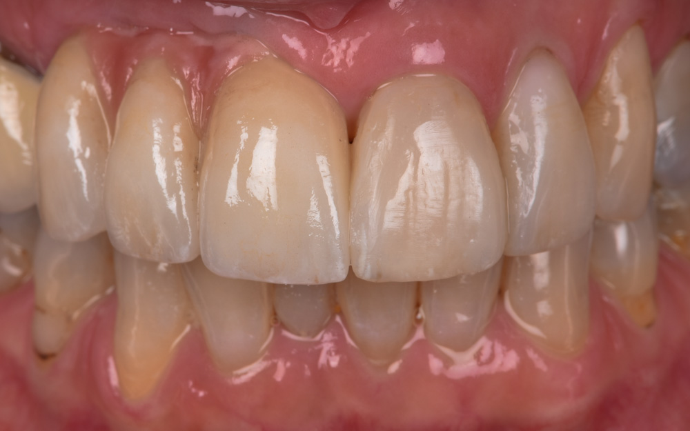 Replacement of Unaesthetic denture with Implant bridge after