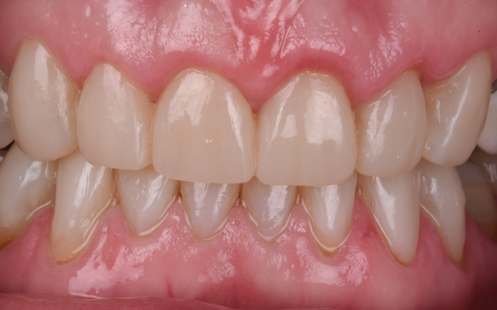 Management of severe tooth wear with composite resin after