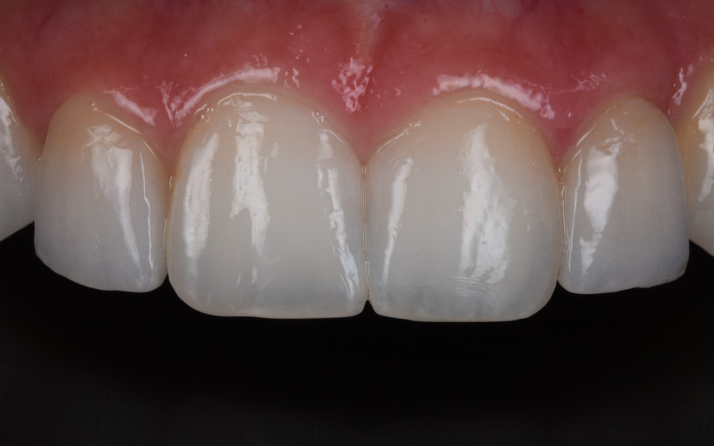 Combination of Gum surgery, composite and ceramics after