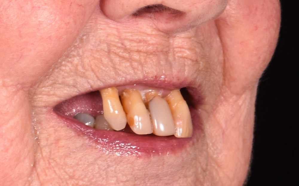 Full arch implant bridges (All-on-4 ) before