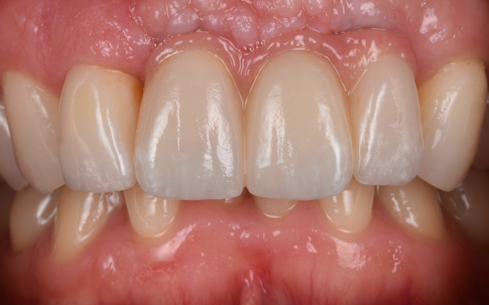 Ceramic Implant bridge with pink replacement after