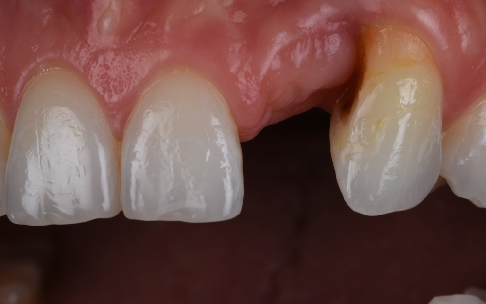 Ceramic bridge replacing Pink gums and Missing teeth before