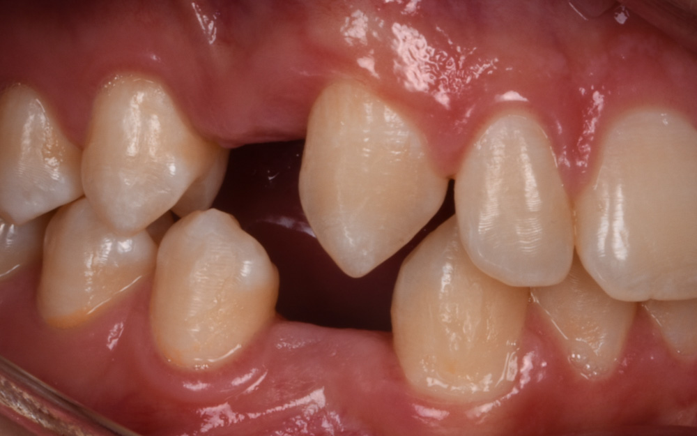 Replacement of congenitally missing premolars Before