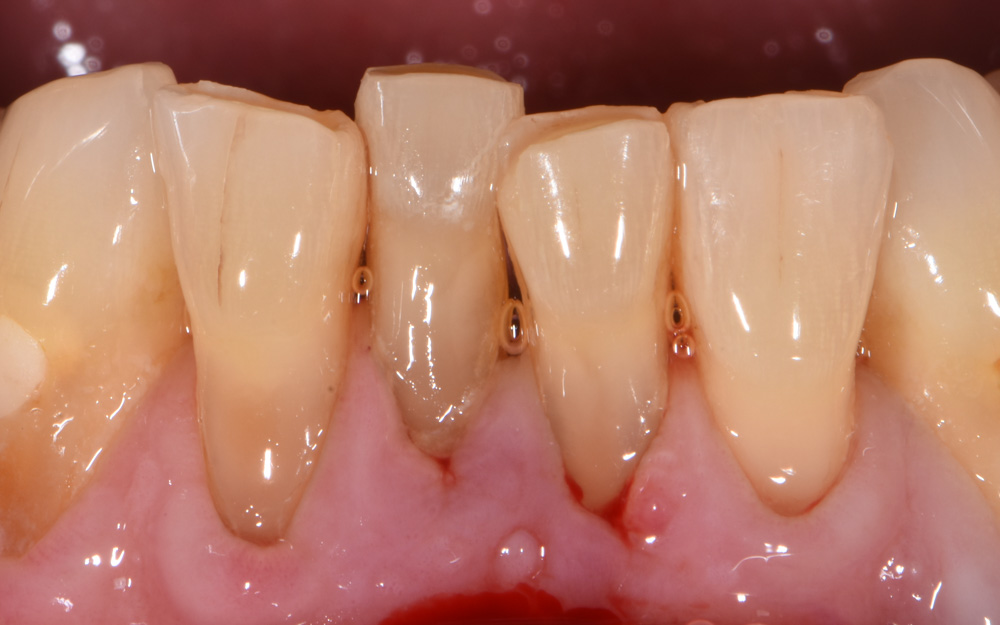 Layered resin bridge replacing two lower Central incisors before