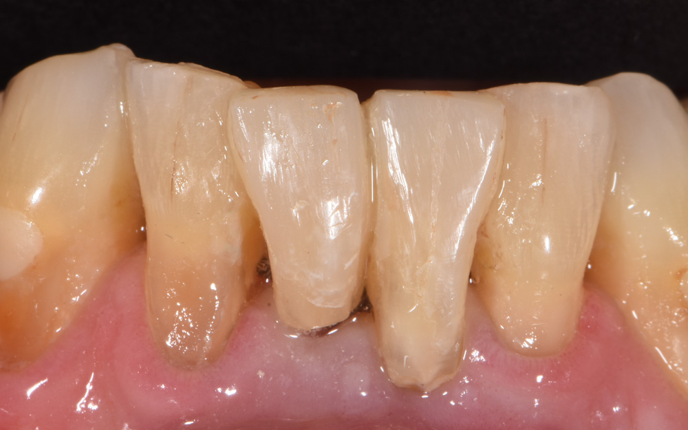 Layered resin bridge replacing two lower Central incisors after