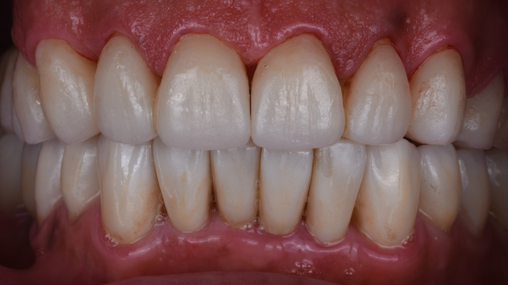 Combination Therapy of a Compromised Dentition after