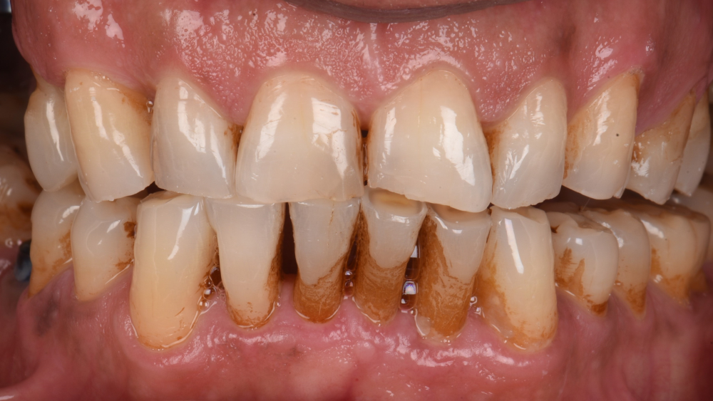 Combination Therapy of a Compromised Dentition b4