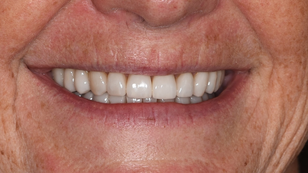 Multidisciplinary Orthodontic and Prosthodontic therapy after