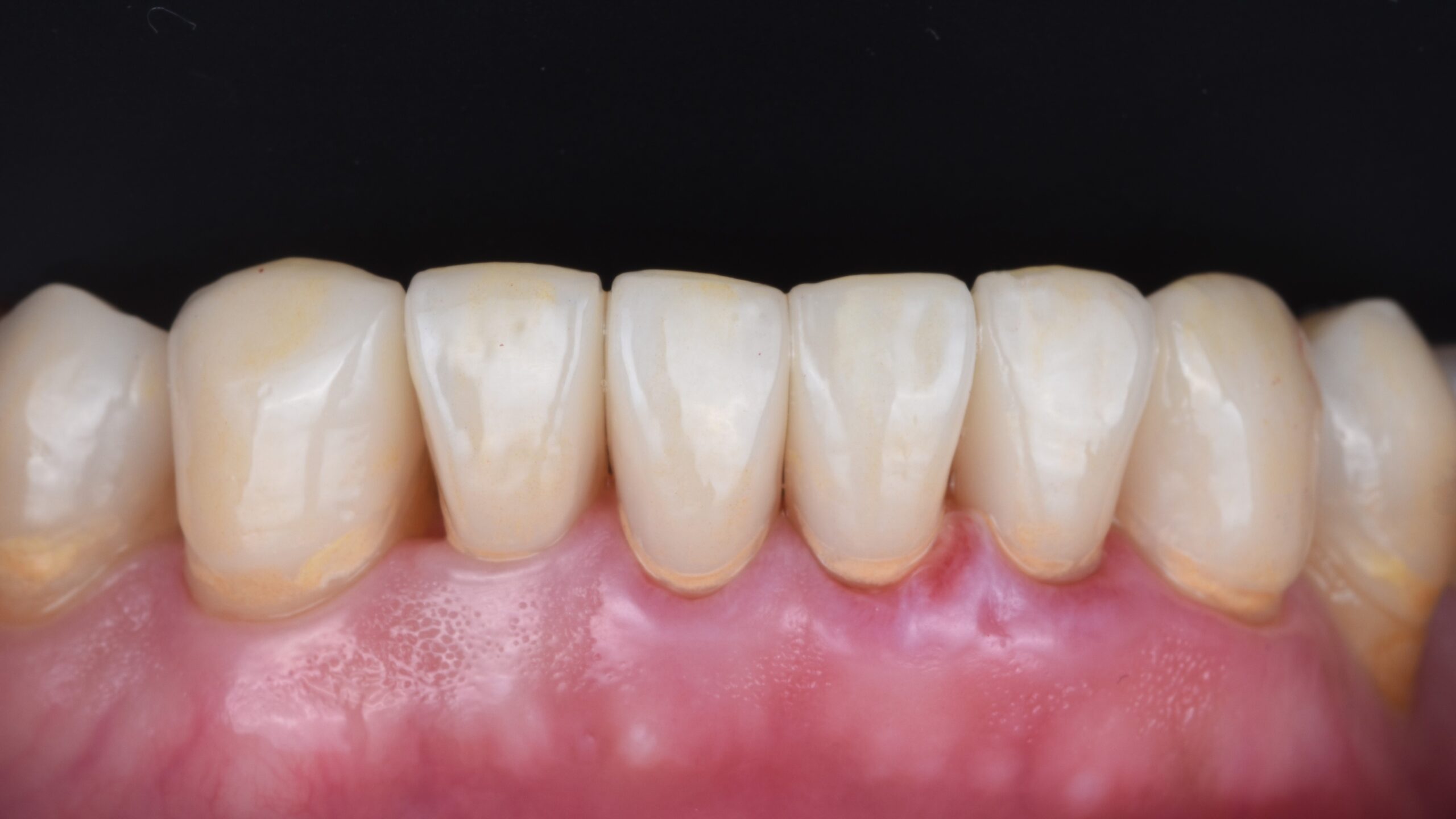 Restoration of severe teeth wear after