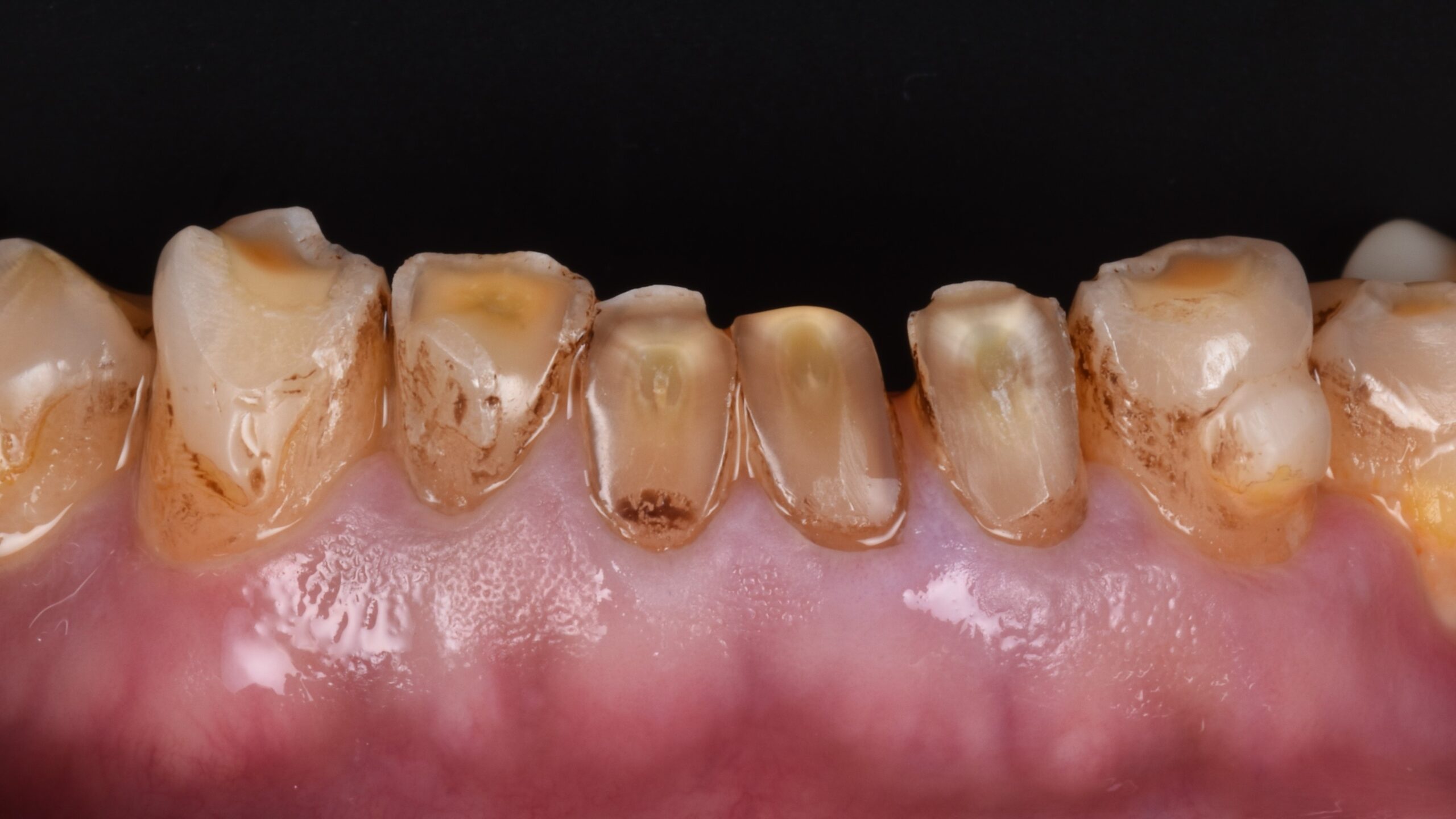 Restoration of severe teeth wear b4